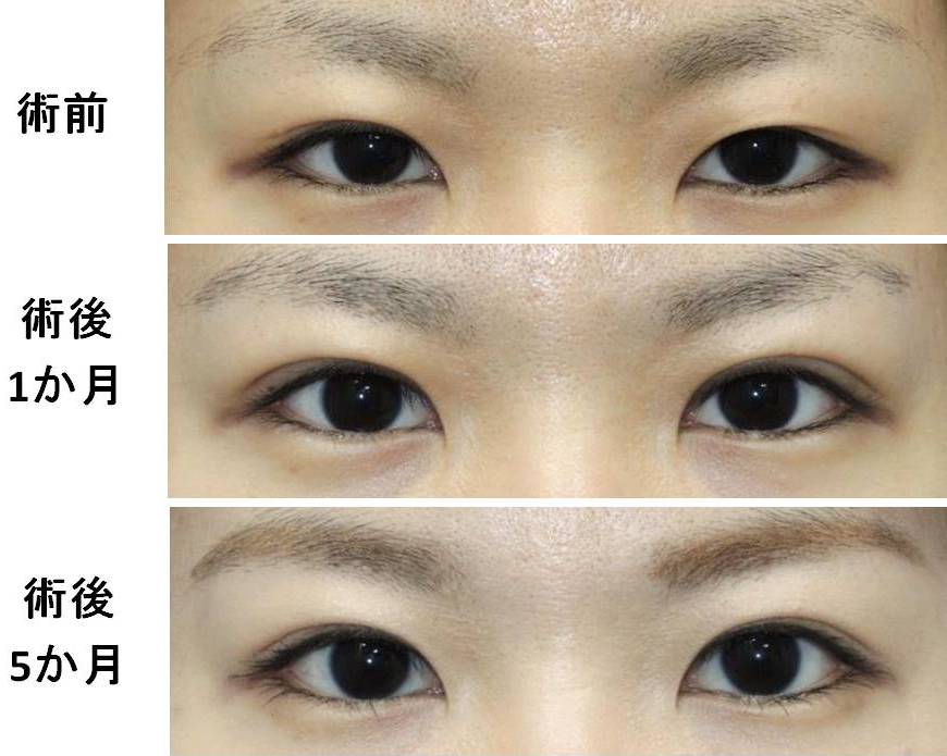 眼の形成 二重切開症例の経過 銀座s美容 形成外科クリニック
